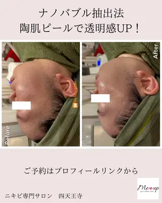 Meupニキビ専門店 背中/ハーブ/肌管理のその他イメージ