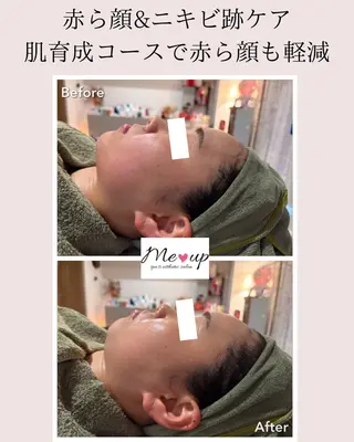 Meupニキビ専門店 背中/ハーブ/肌管理のその他イメージ