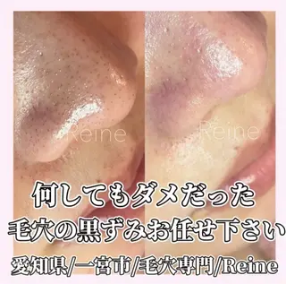 毛穴/シミ肝斑/脱毛 横山梨里のエステ・リラクイメージ