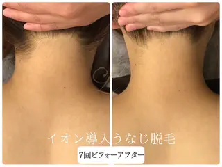 🎀うなじ脱毛🎀 ㅣLino堀江のエステ・リラクイメージ