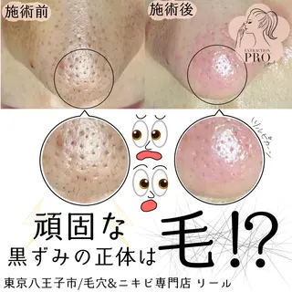 毛穴特化エステ -リールのエステ・リラクイメージ