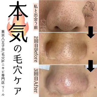 毛穴特化エステ -リールのエステ・リラクイメージ