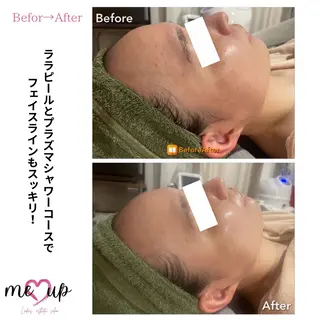 Meupニキビ専門店 背中/ハーブ/肌管理のその他イメージ
