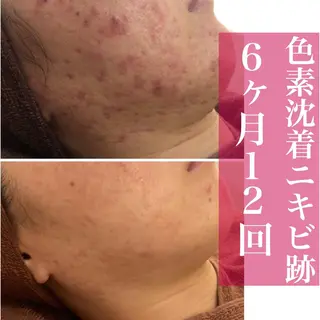 ミディアム カラー パーマ ヘアアレンジ メンズ キッズ ネイル マツエク・マツパ アイブロウ ニキビ・肌質改善専門 ♡人生が変わるサロンのエステ・リラクイメージ