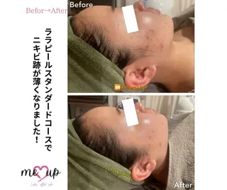Meupニキビ専門店 背中/ハーブ/肌管理のその他イメージ