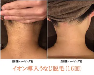 🎀うなじ脱毛🎀 ㅣLino堀江のエステ・リラクイメージ
