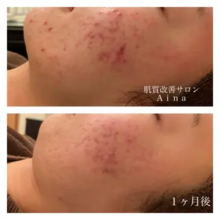 ミディアム カラー パーマ ヘアアレンジ メンズ キッズ ネイル マツエク・マツパ ニキビ跡専門サロン Ainaのエステ・リラクイメージ