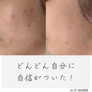 ニキビ経験者が施術 する専門サロン🌻のエステ・リラクイメージ