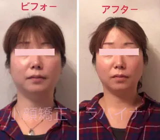小顔矯正 ラハイナのエステ・リラクイメージ