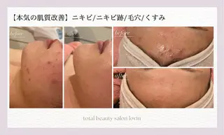 繰り返すニキビ 毛穴悩みの救世主のエステ・リラクイメージ