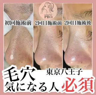 毛穴特化エステ -リールのエステ・リラクイメージ