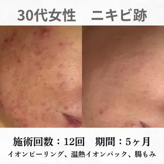 重度ニキビ専門🌷 ダウンタイムなしのエステ・リラクイメージ