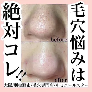 最速 毛穴シミ改善 いくえのその他イメージ
