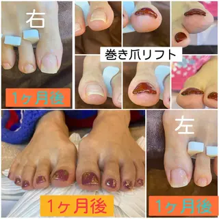 ネイル ♢ME2ROOM♢ #巻き爪#リラクのネイルデザイン