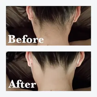 【医療提携】脱毛 小顔ハーブピーリングのその他イメージ