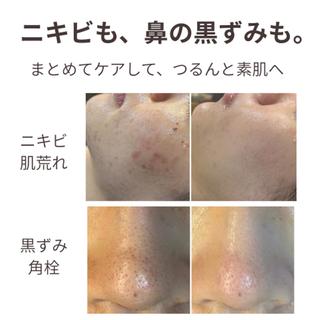 ニキビ・ニキビ跡改善 leoloのエステ・リラクイメージ