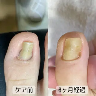 ネイル 巻き爪・肥厚爪ケア 専門サンセリテのネイルデザイン