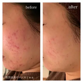 ミディアム カラー パーマ ヘアアレンジ メンズ キッズ ネイル マツエク・マツパ ニキビ跡専門サロン Ainaのエステ・リラクイメージ