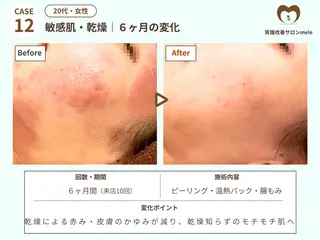 ニキビケア・毛穴専門 mele|もりぞののエステ・リラクイメージ