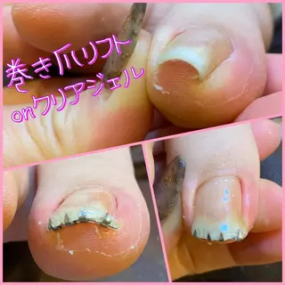 ネイル ♢ME2ROOM♢ #巻き爪#リラクのネイルデザイン