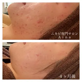 ミディアム カラー パーマ ヘアアレンジ メンズ キッズ ネイル マツエク・マツパ ニキビ跡専門サロン Ainaのエステ・リラクイメージ