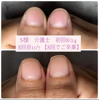 ネイル 自爪育成/深爪矯正 mikiのネイルデザイン