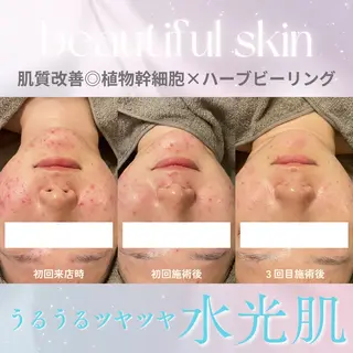 美肌サロン💎ハーブ ピーリング🌿ルプレのエステ・リラクイメージ