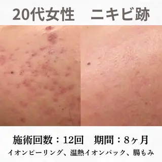 重度ニキビ専門🌼 ダウンタイムなしのエステ・リラクイメージ