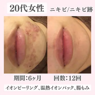 ニキビ・肌質改善専門 ♡人生が変わるサロンのエステ・リラクイメージ