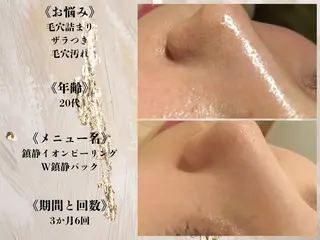 何をしても繰り返す ニキビ・ニキビ跡専門のエステ・リラクイメージ