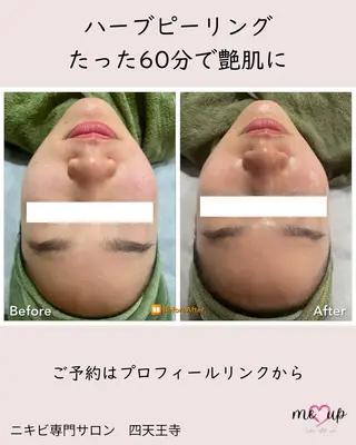 Meupニキビ専門店 背中/ハーブ/肌管理のその他イメージ