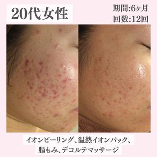 ニキビ・肌質改善専門 ♡人生が変わるサロンのエステ・リラクイメージ