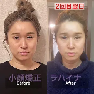 小顔矯正 ラハイナのエステ・リラクイメージ