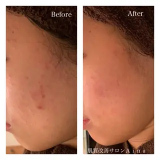 ミディアム カラー パーマ ヘアアレンジ メンズ キッズ ネイル マツエク・マツパ ニキビ跡専門サロン Ainaのエステ・リラクイメージ