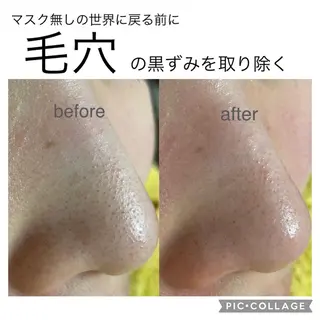 毛穴ケア・肌質改善 徳川のエステ・リラクイメージ