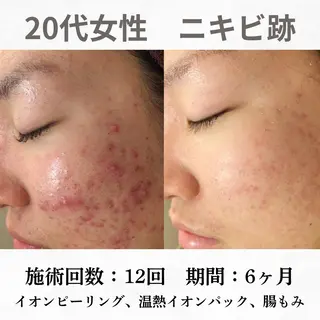 重度ニキビ専門🌼 ダウンタイムなしのエステ・リラクイメージ