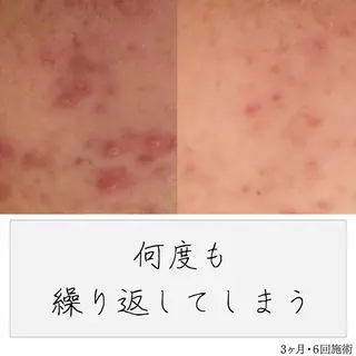 ニキビ経験者が施術 する専門サロン🌻のエステ・リラクイメージ