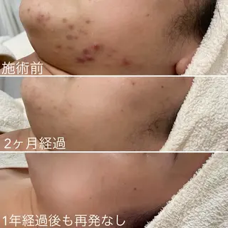 ニキビ・毛穴・ フェイシャル専門店のエステ・リラクイメージ