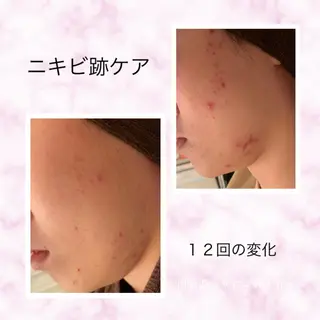 セミロング カラー パーマ ヘアアレンジ メンズ キッズ ネイル マツエク・マツパ ニキビ跡専門サロン Ainaのエステ・リラクイメージ