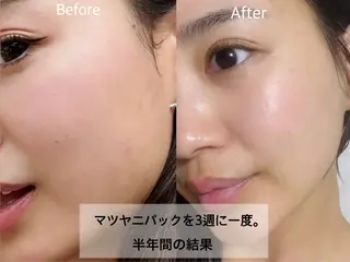 毛穴開き黒ずみ ニキビ特化💆♀️のエステ・リラクイメージ