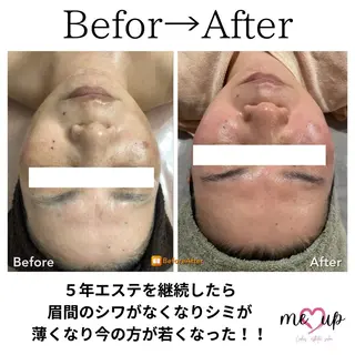 Meupニキビ専門店 背中/ハーブ/肌管理のその他イメージ