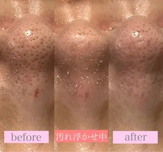 毛穴洗浄🍀脱毛🍀 光フェイシャル🍀のエステ・リラクイメージ