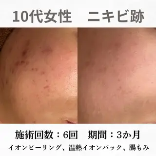 重度ニキビ専門🌼 ダウンタイムなしのエステ・リラクイメージ