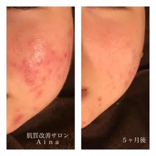 ミディアム カラー パーマ ヘアアレンジ メンズ ネイル マツエク・マツパ ニキビ跡専門サロン Ainaのエステ・リラクイメージ