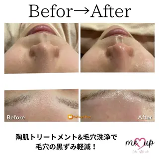 Meupニキビ専門店 背中/ハーブ/肌管理のその他イメージ