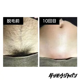 メンズ メンズ脱毛JAPAN 東広島店🇯🇵のエステ・リラクイメージ
