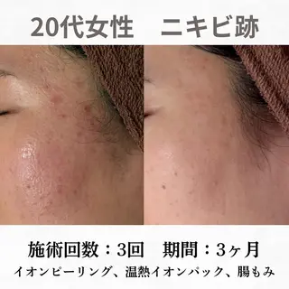 重度ニキビ専門🌷 ダウンタイムなしのエステ・リラクイメージ