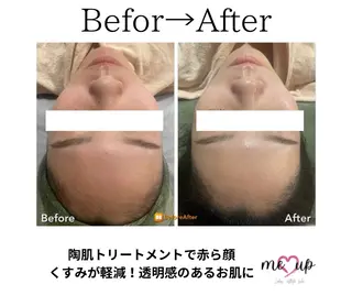 Meupニキビ専門店 背中/ハーブ/肌管理のその他イメージ