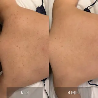 clé skin 🌿ハーブピーリングのエステ・リラクイメージ