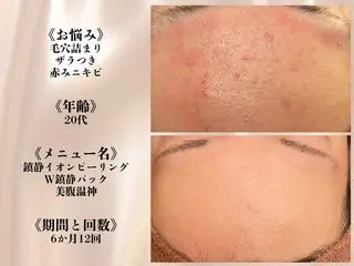 何をしても繰り返す ニキビ・ニキビ跡専門のエステ・リラクイメージ